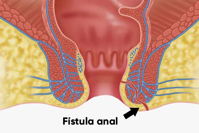 Tratamento das Fistula Anal - Dra. Giovana Zibetti