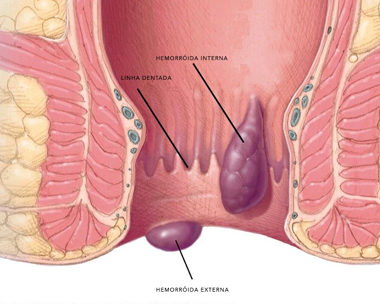 Tratamento das Hemorroidas - Dra. Giovana Zibetti